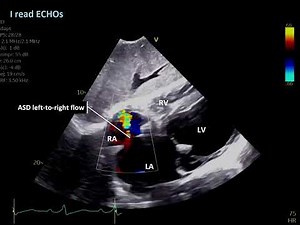 Atrial Septal Defect ASD post MV Clip - ScLAX Color Doppler