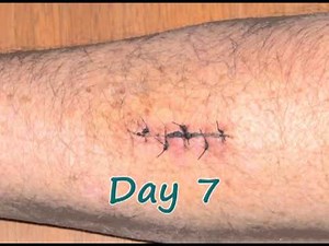 Time Lapse Recovery from Forearm Surgery