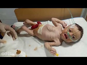 Stoma Care- Changing a Colostomy Bag @Nurse Media