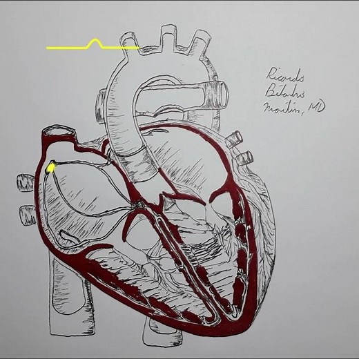 2:1 Atrioventricular block (heart block) explained in 30 seconds
