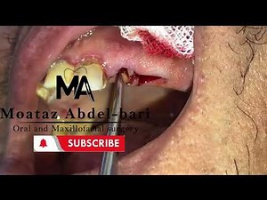 Extraction of Two Fragile Remaining Roots Using a Straight Elevator Only