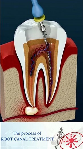 Root Canal Treatment & Tooth Abscess