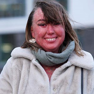 Will my blind date look past my skin condition? | Love Don't Judge