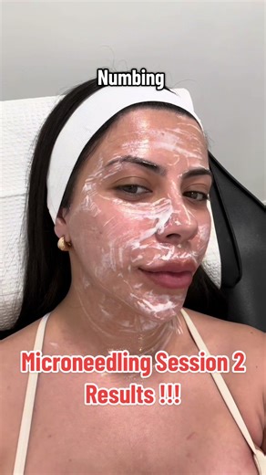 Explore Microneedling Benefits for Acne Scarring