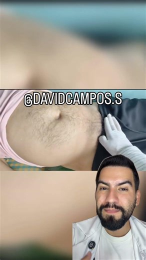 ASÍ SE VE UNA HERNIA