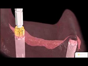 BEGO Easy-Con/ Locator® "Chairside"