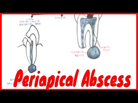 Periapical Abscess: Causes, Symptoms & Treatment