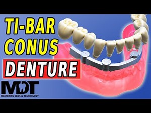 Design a Removable Conus All-On-X with TI-Bar in Exocad
