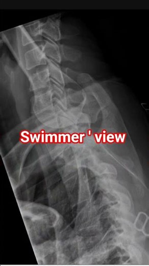 SWIMMER 'S VIEW || C-SPINE SWIMMER 'S LATERAL VIEW