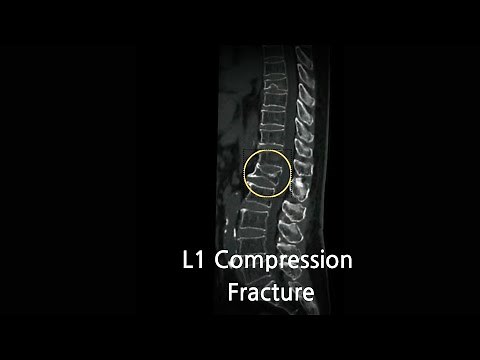 L1 Compression Fractures: Key Causes, Symptoms & Treatments Explained L1 압박 골절: 원인, 증상 및 효과적인 치료법