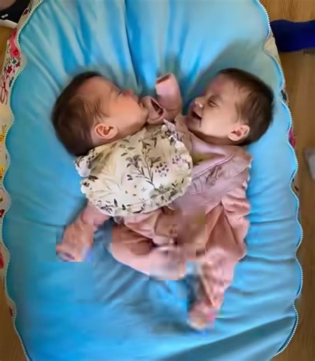 These Siamese twins were born conjoined at the chest and share a liver, intestines and other vital organs 😲 In addition, each sister had only one leg 😱 When they were only 6 months old, doctors decided to separate them. The operation lasted 18 hours, but the doctors successfully separated them. 😍 Today the sisters are 3 years old. Are you curious about what the twins look like after so many years? If so, then the photos of the sisters after separation are presented in the first comment 👇👇👇