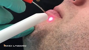 Heidi Christopher shows you how to treat herpetic legions using her AMD LASERS Picasso. This laser can handle all your soft tissue needs: Troughing, frenectomies, operculectomies and much more! www.amdlasers.com | AMD LASERS