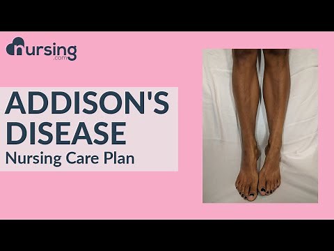 Addisons Disease (Nursing Care Plan)