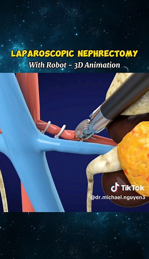 Advanced Laparoscopic Nephrectomy Surgery Techniques