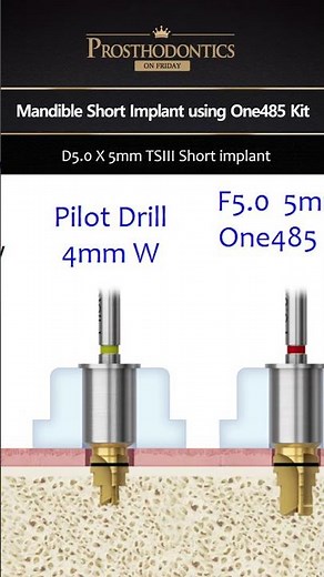 DENALL_FridayProsthodontics_Short Implant #shorts