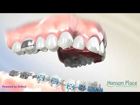 How a Fixed Bite Plate Works