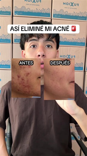 Si estás pasando por lo mismo te comparto esta solución 😊✅ #acne #alphabalance #desintoxicacion