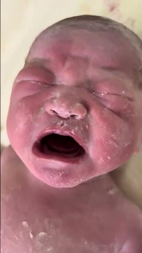 "A newborn baby, crying loudly with tears in their eyes. 🥹👶#NewbornBaby #JustBorn #Newborn #Baby