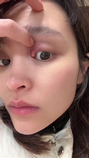 Chưa kịp đi bác sỹ mn ạ. Mk rỏ xong thuốc một chút là nó bùng nổ ra như video trước luôn. Tiện tay nhà có đồ nghề nên mk dứt khoát nặn lôi hết nó ra. Trộm vía giờ đã lành và khỏi hẳn về như ban đầu. Không sẹo không cứng dễ chịu chực kỳ. #xuhuong #xh #xuhuongtiktok #giadinh #giadinhshinbeo