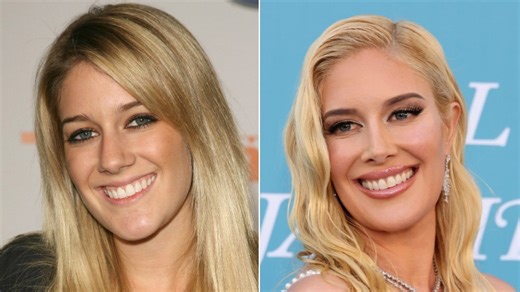Before & after pics of Heidi Montag show her dramatic face transformation