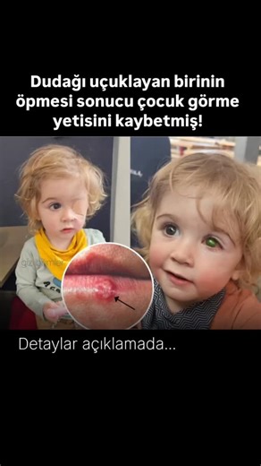 Urfa Flaş Haber on Instagram: "Birleşik Krallık'ta iki yaşındaki bir çocuk, aktif soğuk algınlığı olan bir yetişkin tarafından öpüldükten sonra herpes simplex virüsü tip 1 enfeksiyonu geliştirdi. Virüs gözlerine yayıldı ve küçük çocuklarda nadir ancak ciddi bir durum olan herpes simplex keratitise neden oldu. Doktorlar ilk başta yaygın bir göz enfeksiyonu olarak tedavi ettiler, ancak virüs korneaya zarar vermeye devam etti. Aylarca süren antiviral tedavi ve ameliyat girişimlerine rağmen çocuk et