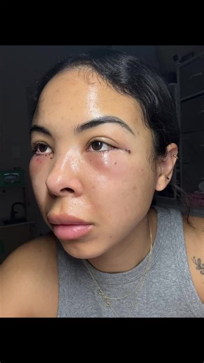 Lower Blepharoplasty Day 2 Recovery Insights