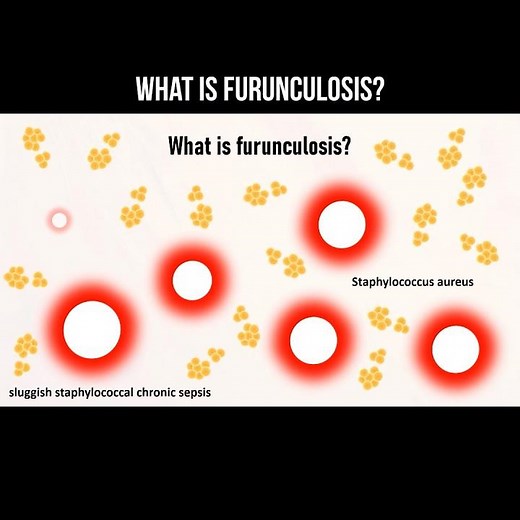 What is furunculosis? #boils #furuncle #skininfection #staphylococcus