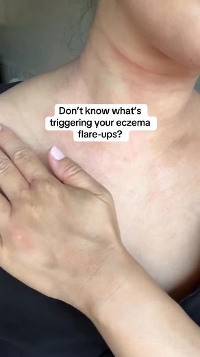 18 reactions | Once you start understanding your eczema triggers,...