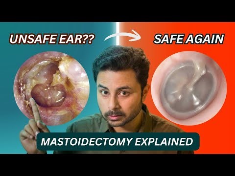 Mastoidectomy Surgery Explained | Cholesteatoma, Bone Infection (Mastoiditis) & Unsafe Ear Treatment
