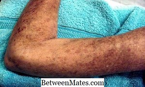 ความแตกต่างระหว่าง Scleroderma กับ CREST ความแตกต่างระหว่าง scleroderma - อื่น ๆ 2025