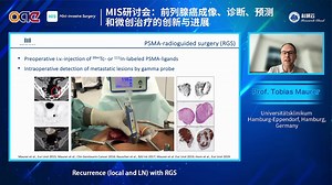 20250430-德国汉堡大学附属埃彭多夫医院Prof. Tobias Maurer-PSMA-radioguided surgery in ........._哔哩哔哩_bilibili