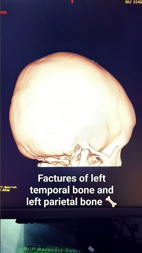 findings. left temporal bone, left parietal bone, mastoid region. like . comments
