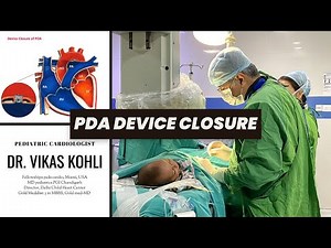 PDA DEVICE CLOSURE BY DR. VIKAS KOHLI || ANGIOPLASTY || CONGENITAL HEART DEFECT (CHD)
