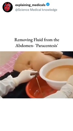 Removing Fluid from the Abdomen- 'Paracentesis'😷🩺