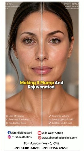 How do doctors decide between Botox, fillers #botoxtreatment #sbaesthetics