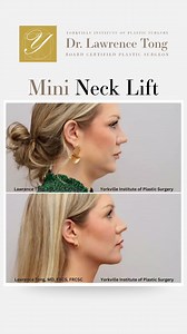 See visible, elegant rejuvenation with Dr. Tong’s Mini Neck Lift, designed for patients who want a smoother, more refined neck without the extensive downtime of a full lift. This procedure targets mild to moderate skin laxity, early banding, and loss of jawline definition. Dr. Tong’s meticulous technique creates natural-looking improvement that enhances your profile from every angle. Explore what a subtle lift can do for your confidence. Tap the link to learn more! | Dr. Lawrence Tong - Yorkvill