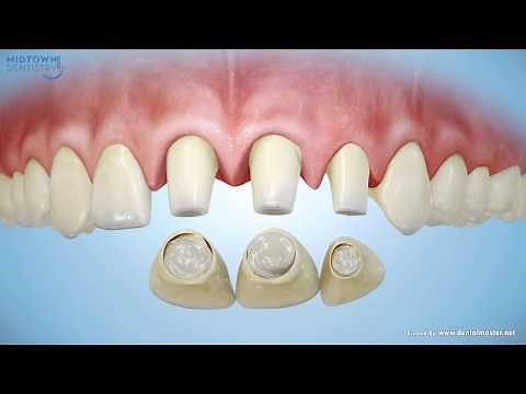 Are Porcelain Veneers Right for You?