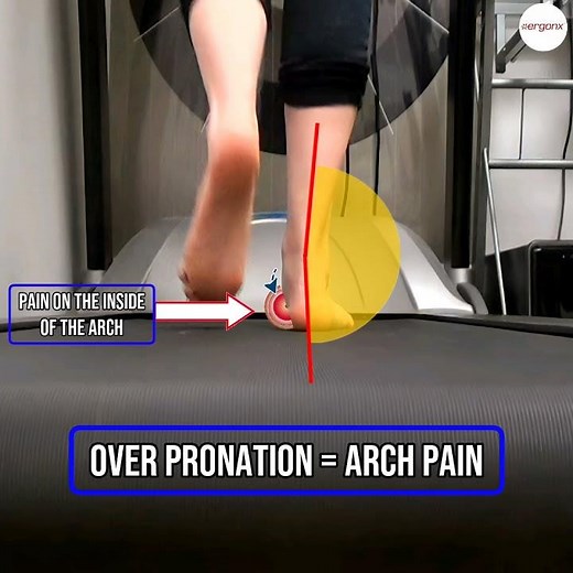 Conquer Arch Pain: Fix Your Foot Mechanics & Overpronation! #FootHealth #Overpronation