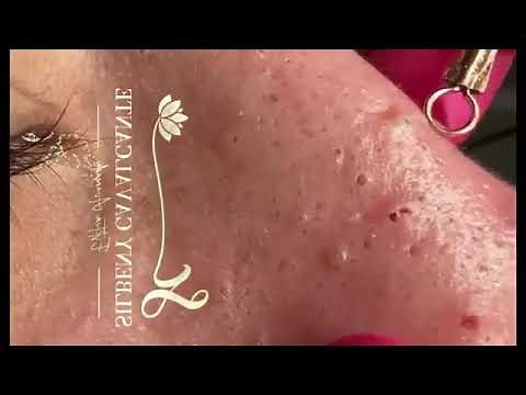 blackhead removal from nose/ old aged blackheads removal | #57