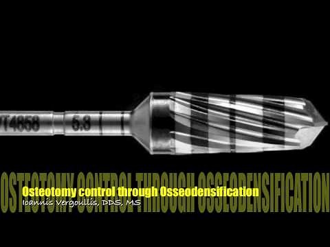 Osteotomy control through Osseodensification