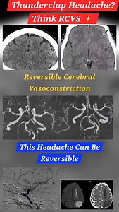 Thunderclap Headache With Normal CT? Think RCVS ⚡🧠 Sudden thunderclap headache with an initially normal CT scan can be misleading 🚨 This reel shows multimodality imaging of Reversible Cerebral Vasoconstriction Syndrome (RCVS)—from CT and MRI to MRA and DSA. 🔍 Key imaging clues: • Cortical subarachnoid hemorrhage • Watershed infarcts on DWI • Multifocal “string-of-beads” vasoconstriction • Reversibility within 3 months (diagnostic hallmark) 💡 Clinical Pearl: Normal early imaging does not excl