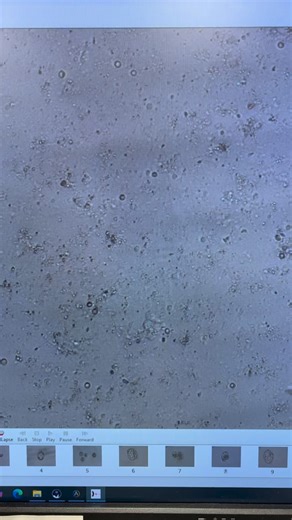 Looking for a needle in a haystack! Azoospermia, or the absence of viable sperm, can make fathering a child nearly impossible, unless we employ one of several sperm extraction techniques to find living sperm. One such technique is testicular epididymal sperm extraction, or TESE for short. This microsurgical technique, performed by Dr. Tolulope Bakare with our reproductive urologist partners at @posterity_health extracts sperm from the testicle to be used in assisted reproduction like IVF. Using 