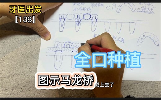 图示：全口种植牙的马龙桥技术，以及是如何实现即刻负重的