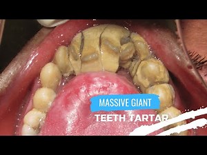 Massive Giant Teeth Tartar Removal Get Rid of Hard Plaque on Teeth #07 🦷 DentalHealth