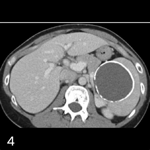 Traumatic splenic laceration with post-traumatic splenic cyst