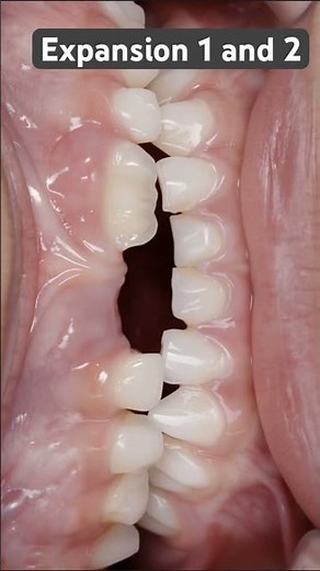 Two rounds of Expansion in early mixed dentition