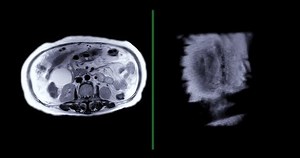 clip-1094184621-magnetic-resonance-cholangiopancreatography-mrcp-axial ...