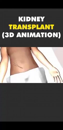 How kidney is transplanted for more amazing videos subscribe our YouTube channel https://www.youtube.com/@Scientificreview488 | The Surgery