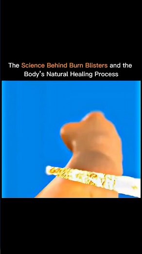 Burn Blister Healing Process