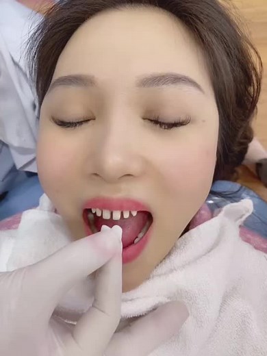 Cosmetic Procedure on Lower Face Enhancements